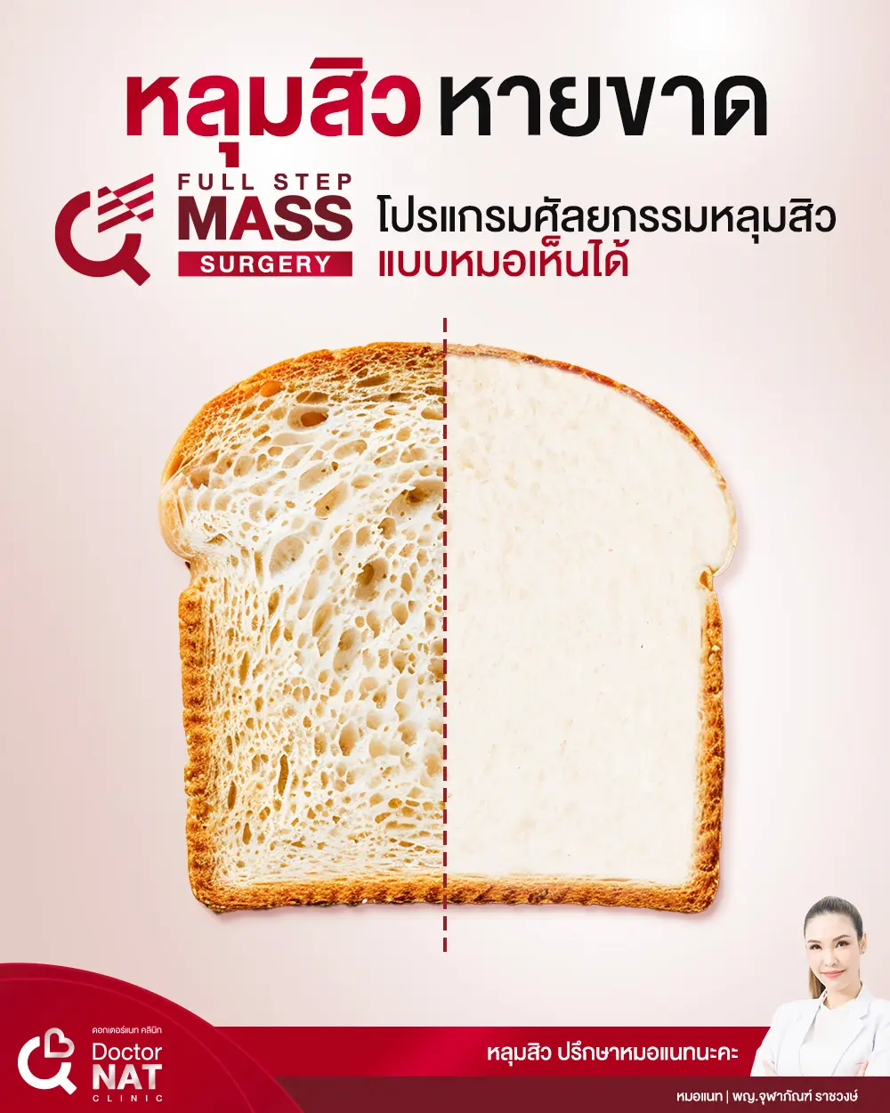 หลุมสิว หายขาด Doctor NAT Clinic